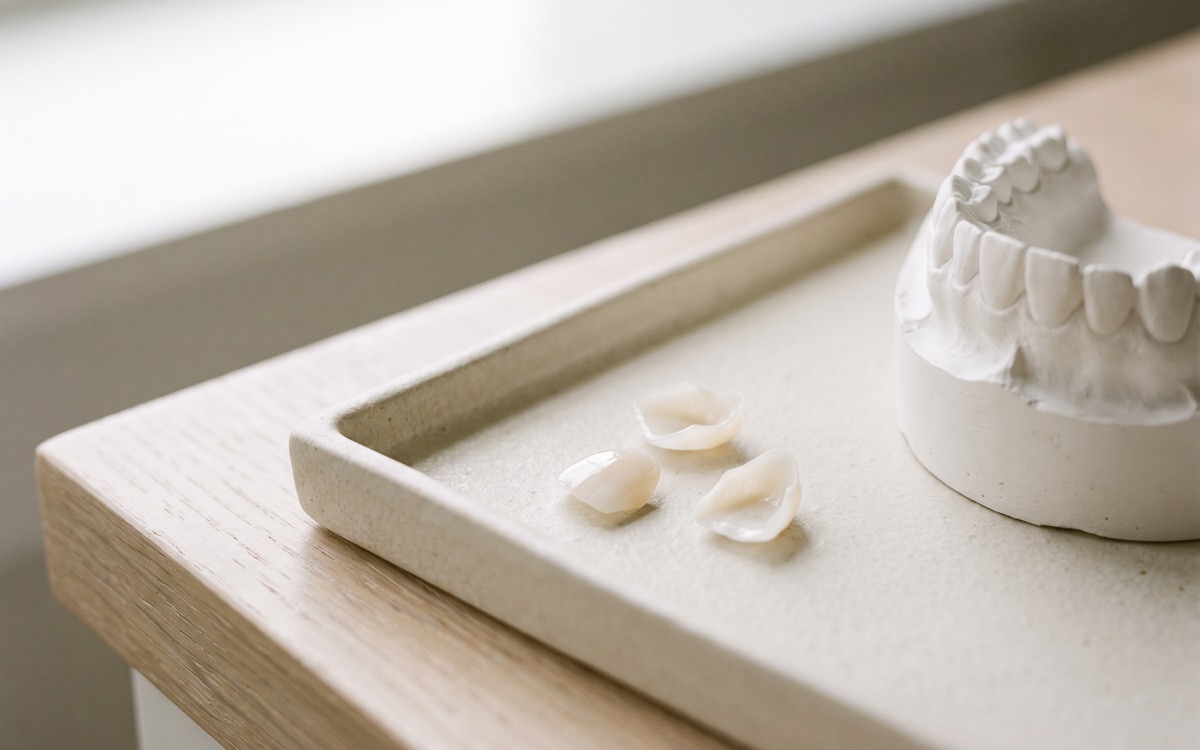 Three hand-finished porcelain veneer shells on a ceramic tray beside a white plaster study model